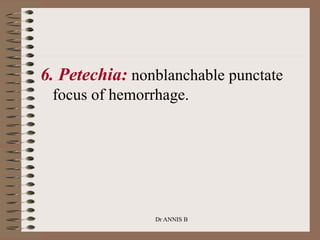 6. Petechia: nonblanchable punctate
focus of hemorrhage.
Dr ANNIS B
 