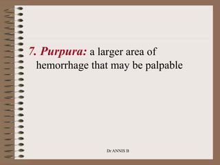 7. Purpura: a larger area of
hemorrhage that may be palpable
Dr ANNIS B
 