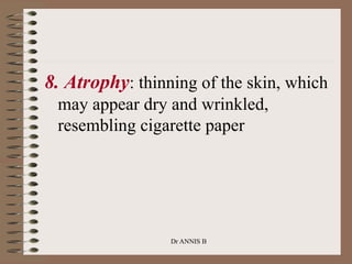 8. Atrophy: thinning of the skin, which
may appear dry and wrinkled,
resembling cigarette paper
Dr ANNIS B
 