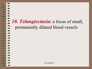 10. Telangiectasia: a focus of small,
permanently dilated blood vessels
Dr ANNIS B
 