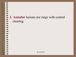 2. Annular lesions are rings with central
clearing.
Dr ANNIS B
 