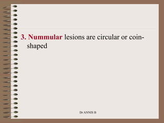 3. Nummular lesions are circular or coin-
shaped
Dr ANNIS B
 