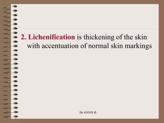 2. Lichenification is thickening of the skin
with accentuation of normal skin markings
Dr ANNIS B
 