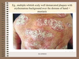 Eg., multiple whitish scaly well demarcated plaques with
erythematous background over the dorsum of hand =
psoriasis
Dr ANNIS B
 