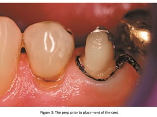 Figure 3: The prep prior to placement of the cord.
 