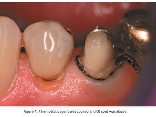 Figure 4: A hemostatic agent was applied and 00 cord was placed
 