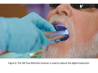 Figure 6: The 3M True Definition Scanner is used to capture the digital impression
 