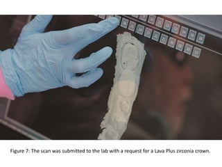 Figure 7: The scan was submitted to the lab with a request for a Lava Plus zirconia crown.
 