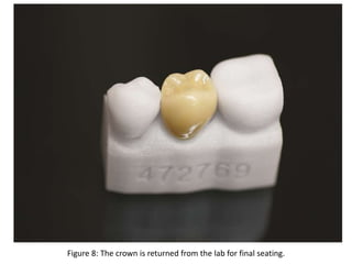Figure 8: The crown is returned from the lab for final seating.
 