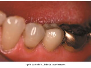 Figure 9: The final Lava Plus zirconia crown.
 