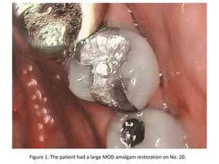 Figure 1: The patient had a large MOD amalgam restoration on No. 20.
 