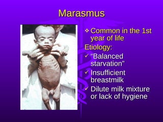 Marasmus Common in the 1st year of life Etiology: “ Balanced starvation” Insufficient breastmilk Dilute milk mixture or lack of hygiene 