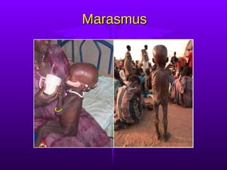 Marasmus 