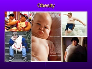 Obesity 