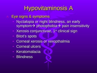 Hypovitaminosis A Eye signs & symptoms Nyctalopia or night blindness, an early symptom   photophobia   pain insensitivity Xerosis conjunctivae, 1 st  clinical sign Bitot’s spots Corneal xerosis or xeropthalmia Corneal ulcers Keratomalacia Blindness  