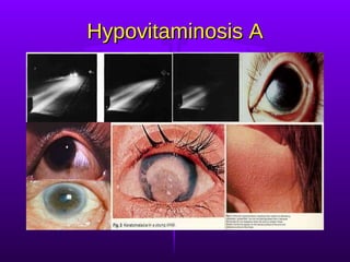Hypovitaminosis A 