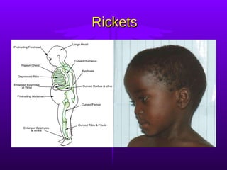 Rickets 