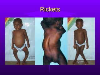 Rickets 
