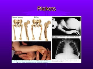 Rickets 