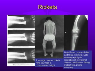 Rickets A teenage male w/ rickets. Note bow legs & compromised height.  Distal femur, proximal tibia and fibula in rickets. Note widening epiphysis, resorption of provisional zone of calcification, flaring metaphysis & bone deformity.  