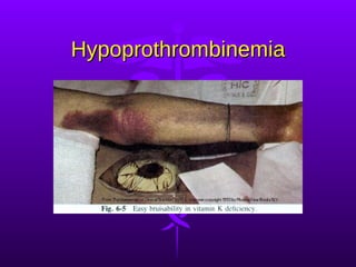 Hypoprothrombinemia 