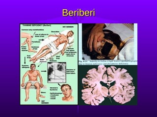 Beriberi 