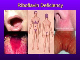 Riboflavin Deficiency 