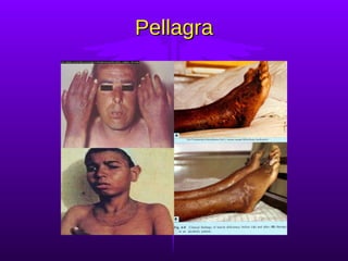 Pellagra 