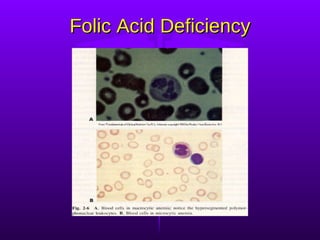 Folic Acid Deficiency 