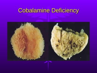 Cobalamine Deficiency 