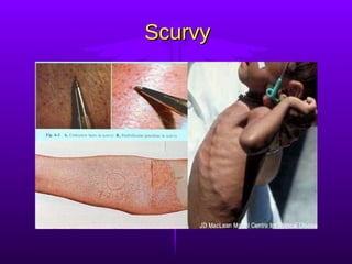 Scurvy 