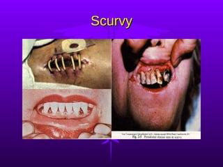 Scurvy 