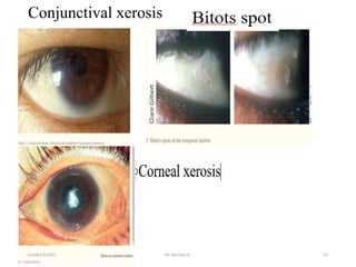 Conjunctival xerosis
october 6/2021 BY:Ayichew A. 52
 