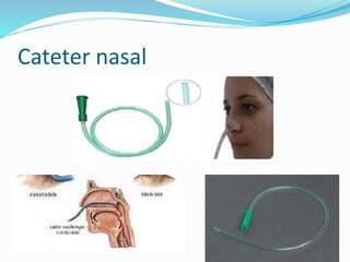 Cateter nasal
 