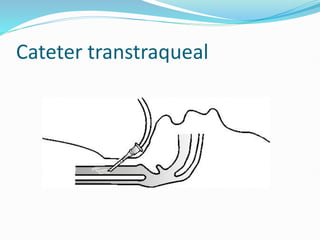 Cateter transtraqueal
 