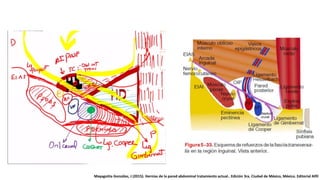 Mayagoitia González, J (2015). Hernias de la pared abdominal tratamiento actual.. Edición 3ra. Ciudad de México, México. Editorial Alfil
 