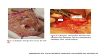 Mayagoitia González, J (2015). Hernias de la pared abdominal tratamiento actual.. Edición 3ra. Ciudad de México, México. Editorial Alfil
 
