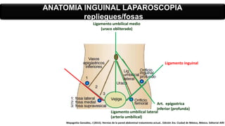 ANATOMIA INGUINAL LAPAROSCOPIA
repliegues/fosas
Ligamento inguinal
Ligamento umbilical medio
(uraco obliterado)
Ligamento umbilical lateral
(arteria umbilical)
Art. epigastrica
inferior (profunda)
Mayagoitia González, J (2015). Hernias de la pared abdominal tratamiento actual.. Edición 3ra. Ciudad de México, México. Editorial Alfil
 