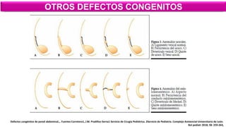 OTROS DEFECTOS CONGENITOS
Defectos congénitos de pared abdominal.,. Fuentes-Carretero1, J.M. Pradillos-Serna1 Servicio de Cirugía Pediátrica. 2Servicio de Pediatría. Complejo Asistencial Universitario de León.
Bol pediatr 2018; 58: 259-264,
 
