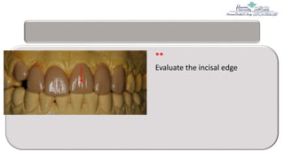 3= Permanent maxillary Central incisor.pptx