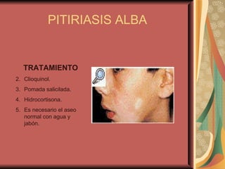 PITIRIASIS ALBA TRATAMIENTO Clioquinol. Pomada salicilada. Hidrocortisona. Es necesario el aseo normal con agua y jabón. 