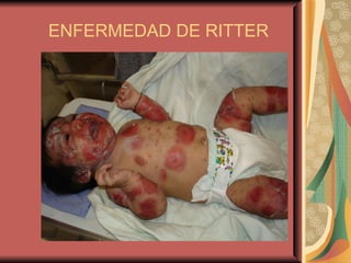 ENFERMEDAD DE RITTER 