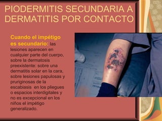 PIODERMITIS SECUNDARIA A DERMATITIS POR CONTACTO Cuando el impétigo es secundario:   las lesiones aparecen en cualquier parte del cuerpo, sobre la dermatosis preexistente: sobre una dermatitis solar en la cara, sobre lesiones papulosas y pruriginosas de la escabiasis  en los pliegues  o espacios interdigitales y no es excepcional en los niños el impétigo generalizado. 
