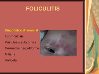 FOLICULITIS Diagnóstico diferencial : Furunculosis Pústulosis subcórnea Dermatitis herpetiforme Miliaria Varicela 