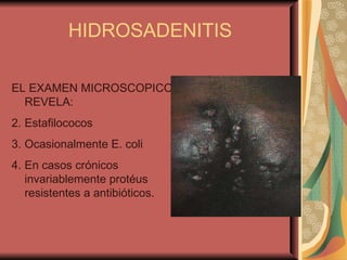 HIDROSADENITIS EL EXAMEN MICROSCOPICO REVELA: Estafilococos Ocasionalmente E. coli En casos crónicos invariablemente protéus resistentes a antibióticos. 