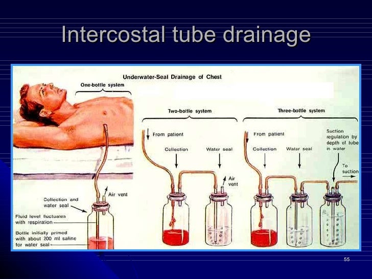 3 Pneumothorax