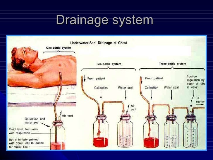 3 pneumothorax