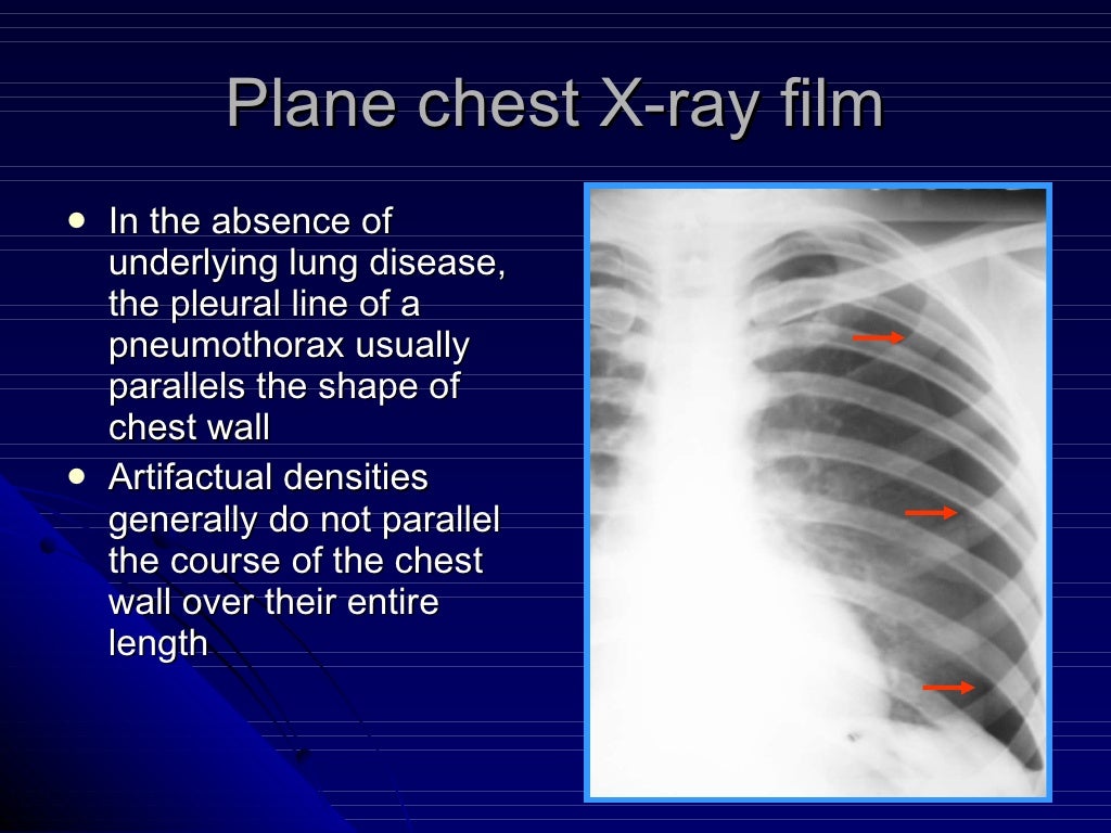 3 pneumothorax