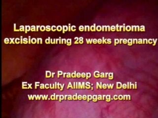 Laparoscopic endometrioma excision in Pregnancy, Mob: 7280015430, www.drpradeepgarg.com