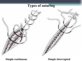 Simple Continuous Pattern Surgery 3 print version nurses basics of vascular surgery Open heart surgery | PPT